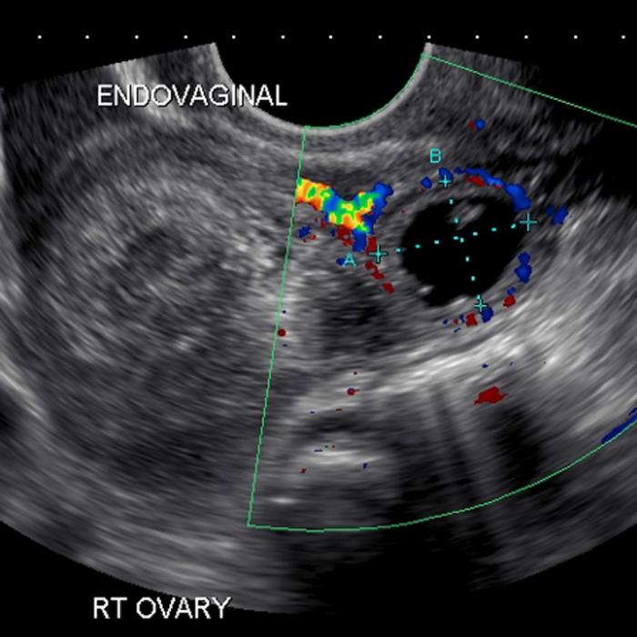 Ectopic pregnancy hesi case study