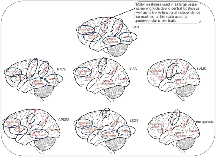 Stroke severity tool for large vessel occlusion